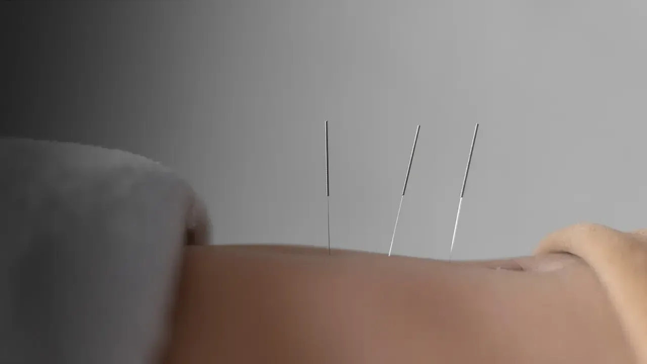 Fine acupuncture needles placed along a patient's back.