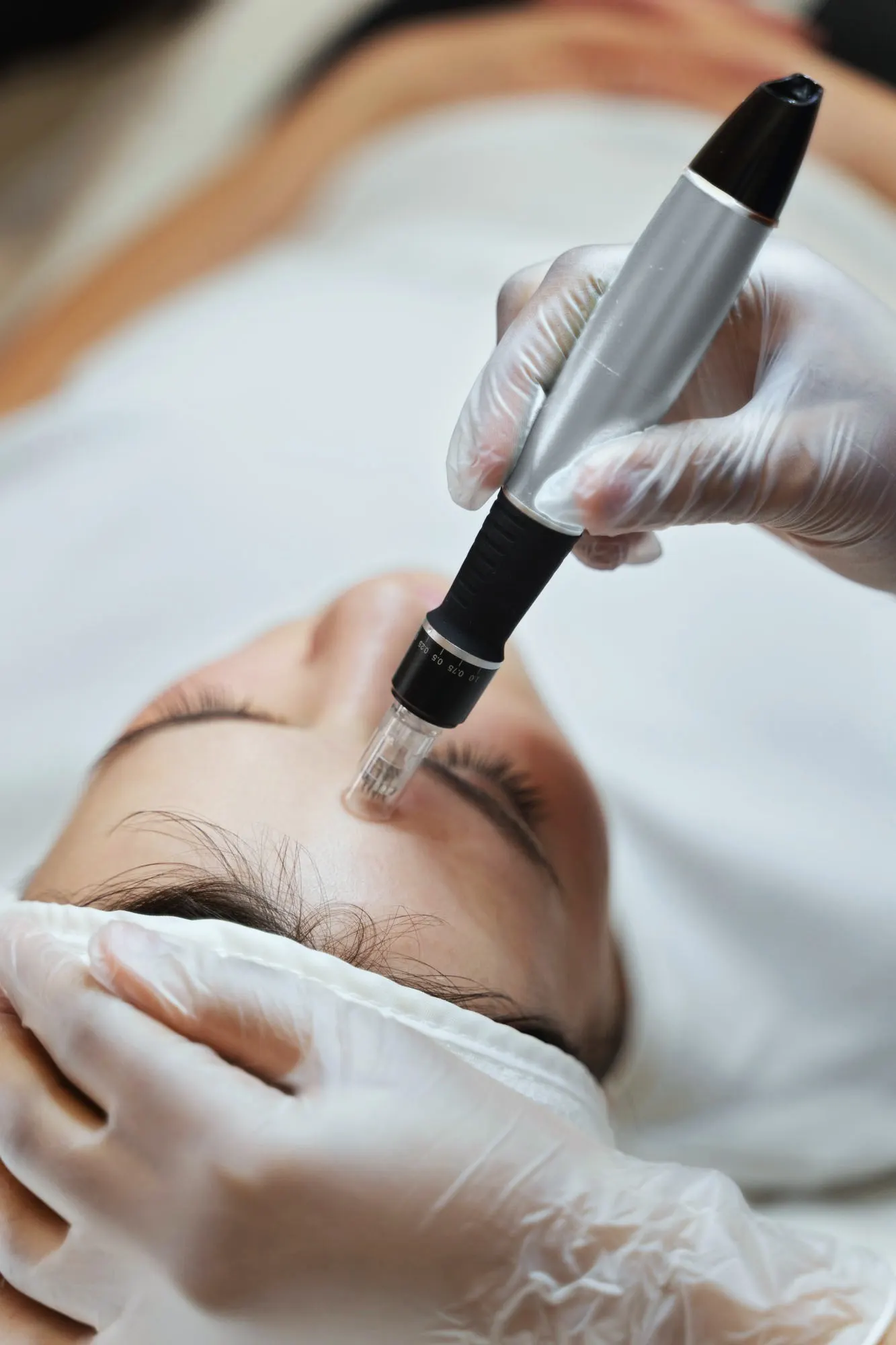 A patient receiving a microneedling treatment.